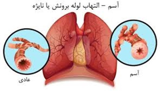 “هوایی سالم برای همه: روز جهانی آسم”